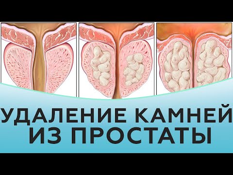 Видео: Удаление камней из простаты