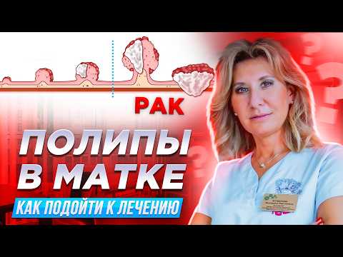 Видео: Полипы в матке: главные факты, которые важно знать каждой женщине