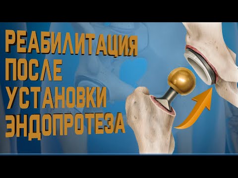 Видео: Реабилитация после эндопротезирования. Все что нужно знать!  | Доктор Демченко