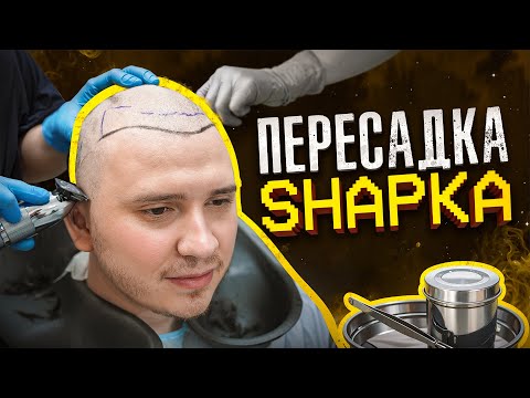 Видео: ПЕРЕСАДКА ВОЛОС SHAPKA