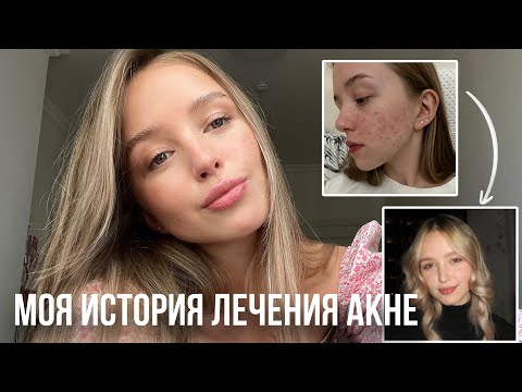 Видео: Как ВЫЛЕЧИТЬ ПРЫЩИ? // Про системные ретиноиды (роаккутан)