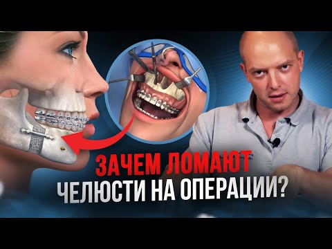 Видео: Как исправляют прикус хирургическим путем? Ортогнатическая хирургия.