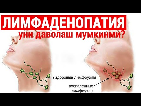 Видео: Лимфаденопатия бедаво касалликми?