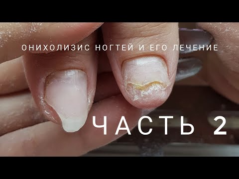 Видео: Oнихолизис часть 2, как вылечить онихолизис. Что такое онихолизис. Проблемные ногти.