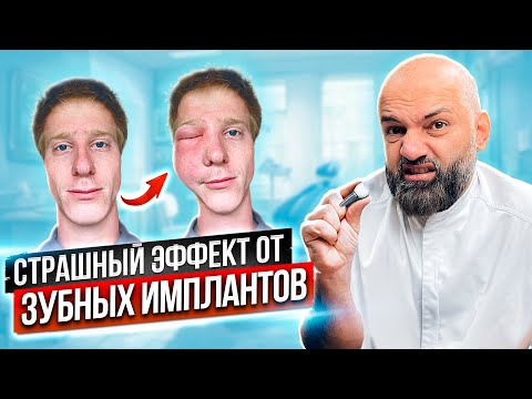 Видео: Самые частые жалобы после имплантации зубов. Какие возможные последствия от имплантации зуба