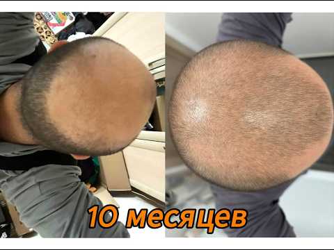 Видео: Использовал миноксидил и финастерид 10 месяцев - что вышло?