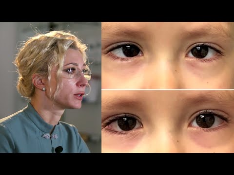 Видео: ТОП вопросов и ответов о косоглазии и его лечении