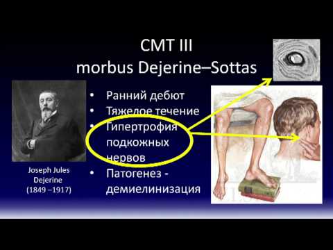 Видео: Болезнь Шарко-Мари