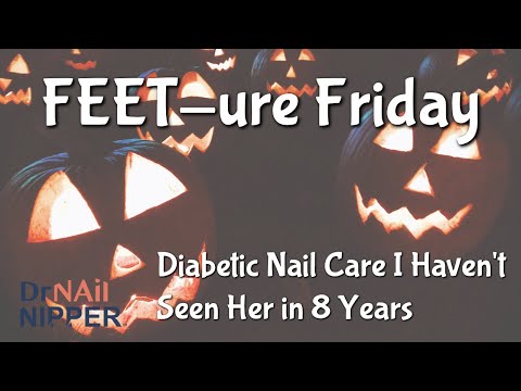 Видео: FEET-ure Friday | Очень толстые ногти и 8-летний перерыв #толстыеногти