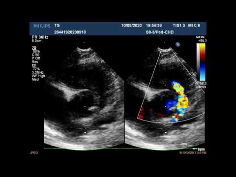 Видео: Эхо КГ с анализом тетрада фалло (рус. перевод)