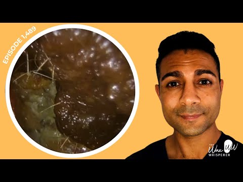 Видео: 1488 — Узнайте больше обо мне и посмотрите удаление ушной серы у пациента с множественными холест...