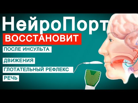 Видео: НЕЙРОПОРТ ВОССТАНОВИТ ПОСЛЕ ИНСУЛЬТА движения, глотание, равновесие, речь.