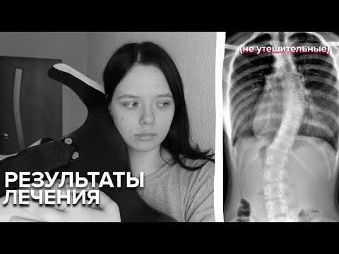 Видео: Результаты лечения и первая паническая атака! Сколиоз 3 степени. Моя история.