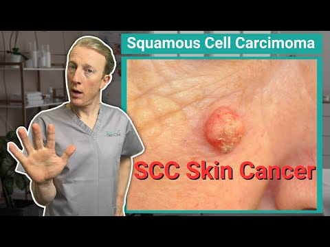 Видео: Плоскоклеточный рак кожи (ПКР): что нужно знать для раннего выявления и лечения