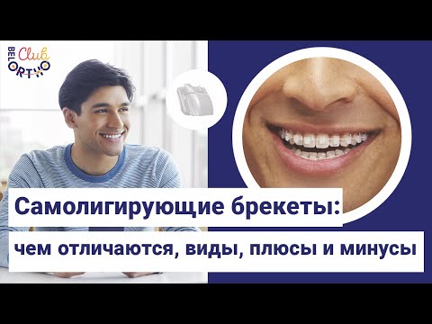 Видео: Самолигирующие брекеты – чем отличаются, виды, плюсы и минусы |БелОртоКлуб