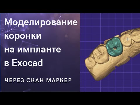 Видео: Коронка на импланте за 30 минут в Exocad. Design implant crown with scan-marker