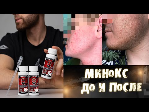 Видео: Что стало с бородой после 3 лет отмены Миноксидила? Выпуск №25 Как запустить рост бороды