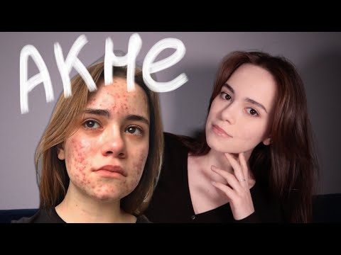 Видео: Моя ужасная история акне. Как я вылечила кожу от прыщей?