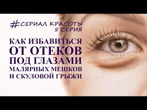 Видео: как убрать отеки под глазами, грыжи и  малярные мешки. омоложение глаз