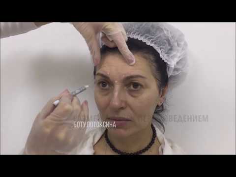 Видео: Диспорт инъекции в клинике доктора Гришкяна