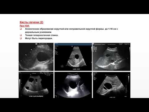 Видео: Ультразвуковая диагностика. Доктор Иогансен. Выпуск 11. Неопухолевые очаговые изменения печени.