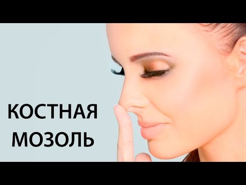 Видео: КОСТНАЯ МОЗОЛЬ // РИНОПЛАСТИКА