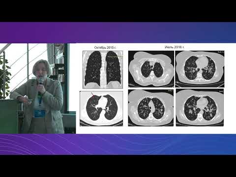 Видео: Васкулиты в клинической практике - как заподозрить и как диагностировать? - Зайцева Анна Сергеевна