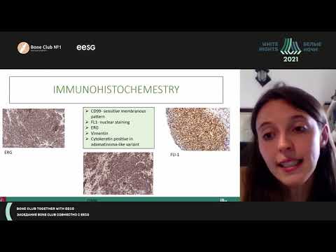 Видео: Классическая саркома Юинга, локализующаяся в костях (Mariavittoria Vescovo)