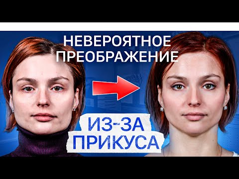 Видео: Как прикус влияет на асимметрию лица? Исправление прикуса ДО и ПОСЛЕ