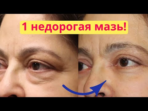 Видео: ВСЕГО 1 мазь! Как убрать мешки под глазами, морщины под глазами, отеки век , синяки под глазами.