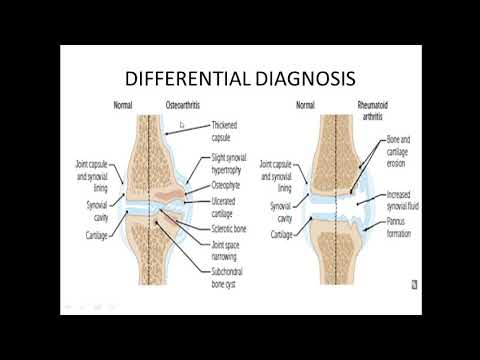 Видео: РЕВМАТОЙД АРТРИТ by Tsengel