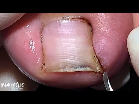 Видео: ЗАХВАТЫВАЮЩЕЕ ВИДЕНИЕ ВРОСШЕГО НОГТИ!!