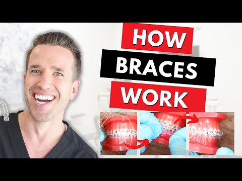 Видео: Как работают брекеты? | Доктор Нейт | Ортодонт