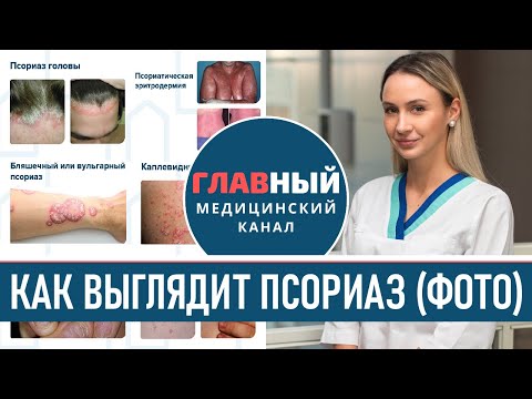 Видео: Как выглядит псориаз (фото 1-9). Симптомы псориаза на голове, руках и ногах. Как начинается псориаз
