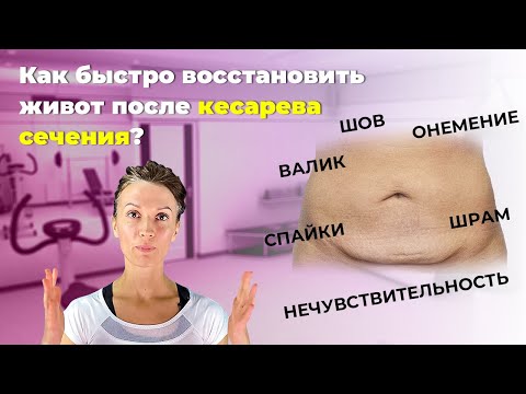 Видео: Восстановление живота после кесарева. Что делать? Чего нельзя? Приемы, о которых мало кто знает