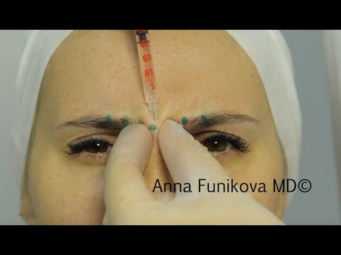 Видео: Видео-инструкция по применению ботулотоксина - estet-portal.com