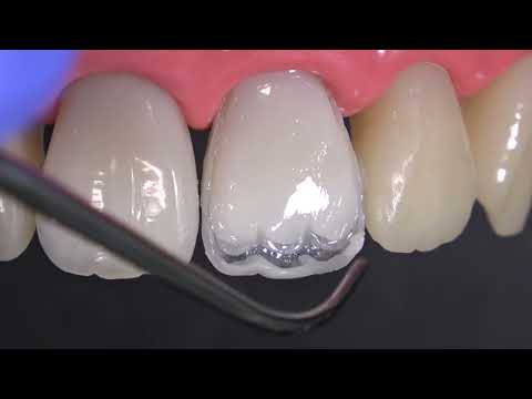 Видео: Протокол многослойной прямой композитной реставрации переднего зуба материалом HARMONIZE (Kerr)