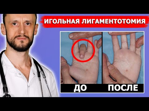 Видео: Болезнь Нотта (щелкающий палец) и контрактура Дюпюитрена | ЛЕЧЕНИЕ | 100% результат без шрамов