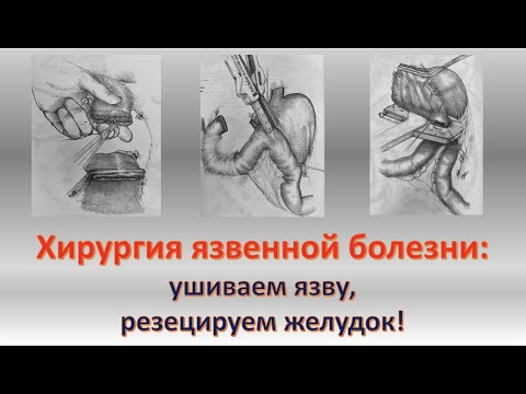 Видео: Хирургия язвенной болезни (часть 1)