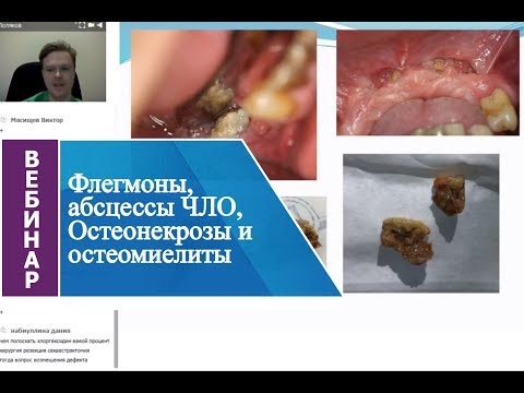 Видео: Вебинар «Флегмоны, абсцессы ЧЛО, Остеонекрозы и остеомиелиты».