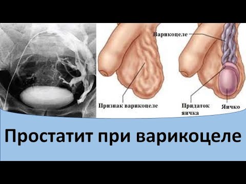 Видео: Простатит при варикоцеле