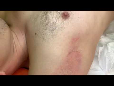 Видео: Мужчина (подмышки) на Evolution 7HD