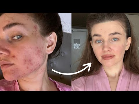 Видео: Как я улучшила кожу без косметолога