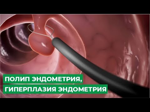 Видео: Полип эндометрия, гиперплазия эндометрия