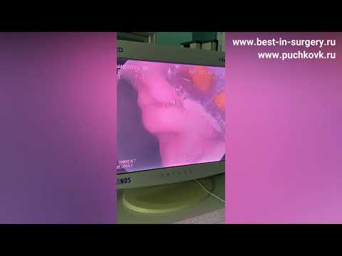 Видео: Радиочастотная абляция при пищеводе Баррета