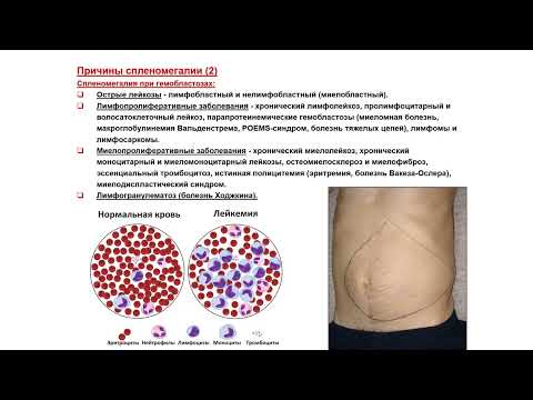 Видео: УЗИ. Доктор Иогансен. Выпуск 61. Спленомегалия и диффузные изменения селезенки. Часть 1.