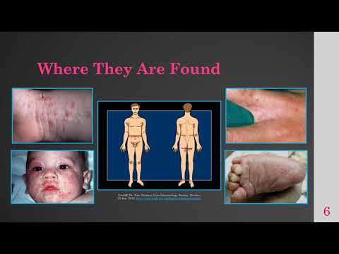 Видео: Видео о чесотке