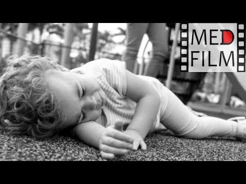 Видео: Височная эпилепсия, лечение © Temporal lobe epilepsy
