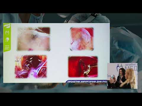 Видео: 68. Ендоскопски метод за вземане на венозен графт при пациенти подлежащи на АКБ, Endoscopic vein ...