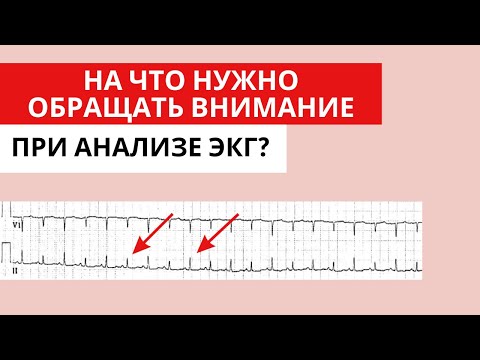 Видео: Что НЕ стоит игнорировать при анализе ЭКГ?  На что стоит обращать внимание при анализе ЭКГ?
